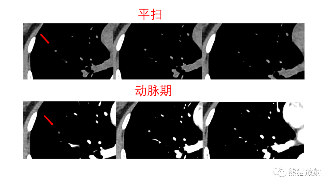 影像PPT - 【病例】支气管腺瘤2例CT影像-13
