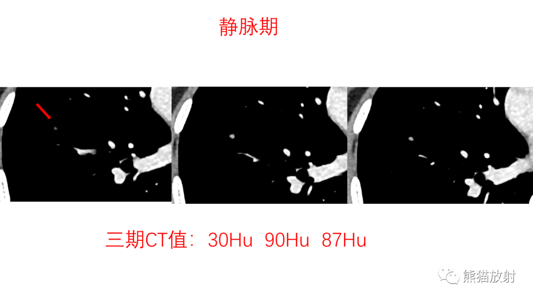 影像PPT - 【病例】支气管腺瘤2例CT影像-14