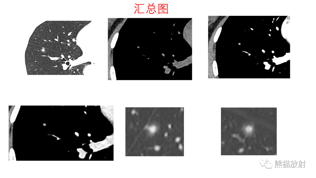 影像PPT - 【病例】支气管腺瘤2例CT影像-16