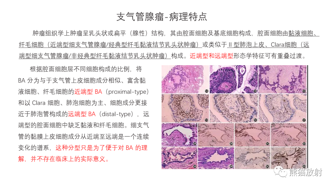 影像PPT - 【病例】支气管腺瘤2例CT影像-20