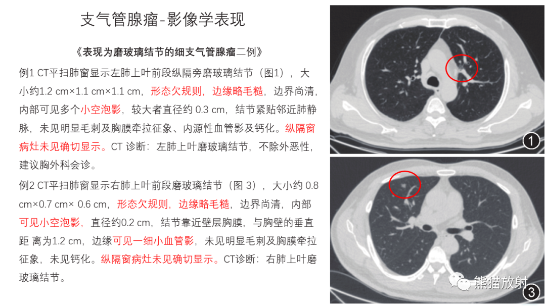 影像PPT - 【病例】支气管腺瘤2例CT影像-24