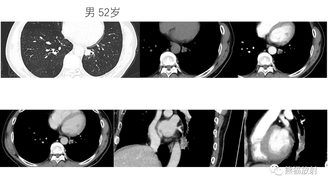 影像PPT - 【病例】支气管腺瘤2例CT影像-22