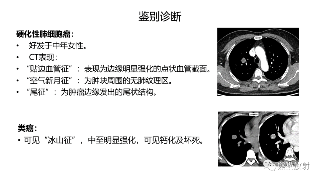 影像PPT - 【病例】支气管腺瘤2例CT影像-30