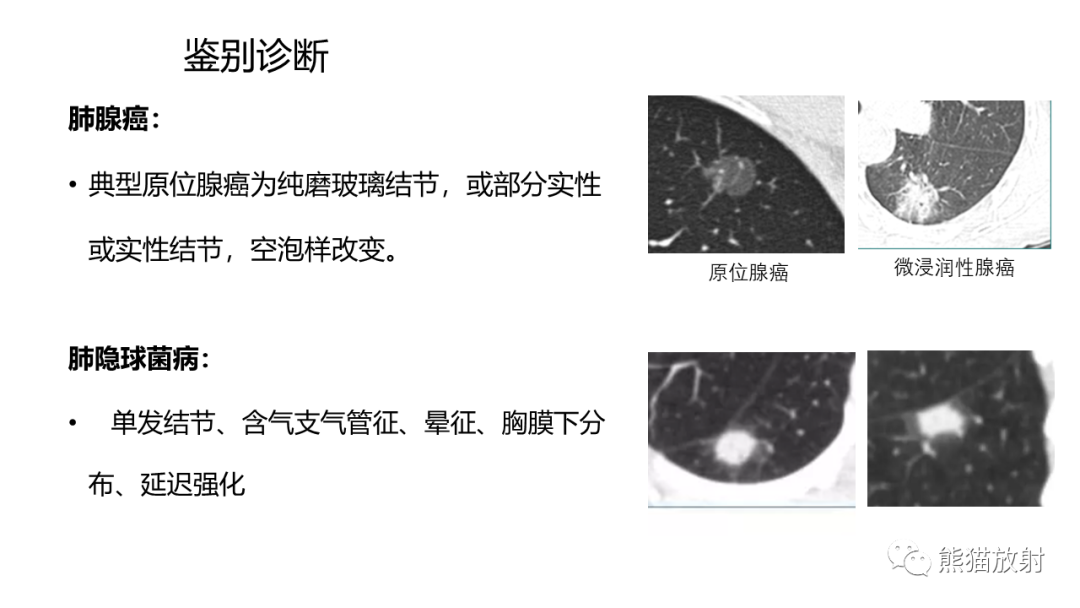 影像PPT - 【病例】支气管腺瘤2例CT影像-28