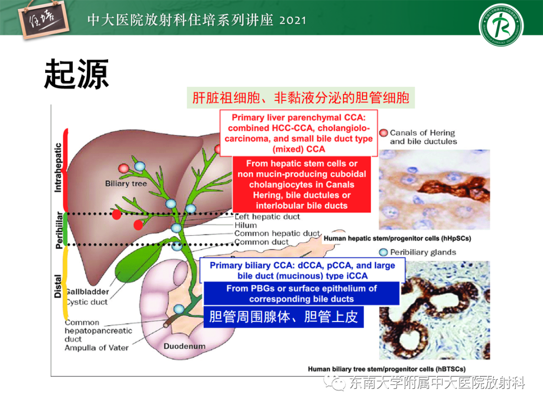 影像PPT - 【PPT】胆管细胞癌的影像表现与鉴别-6