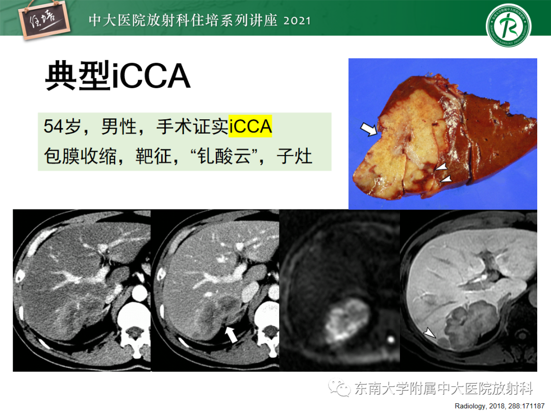 影像PPT - 【PPT】胆管细胞癌的影像表现与鉴别-9