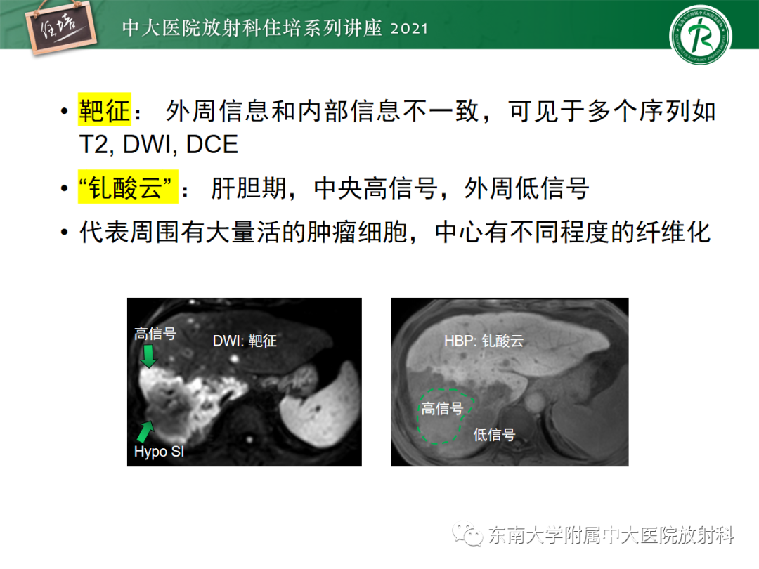 影像PPT - 【PPT】胆管细胞癌的影像表现与鉴别-8