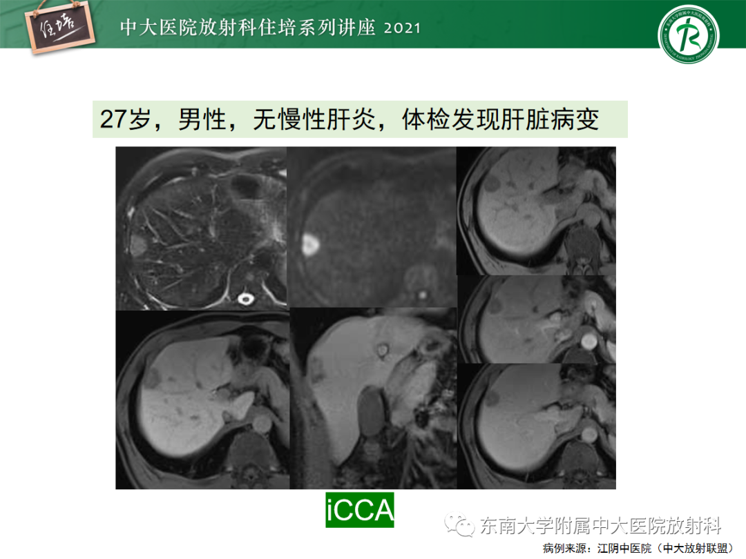 影像PPT - 【PPT】胆管细胞癌的影像表现与鉴别-10