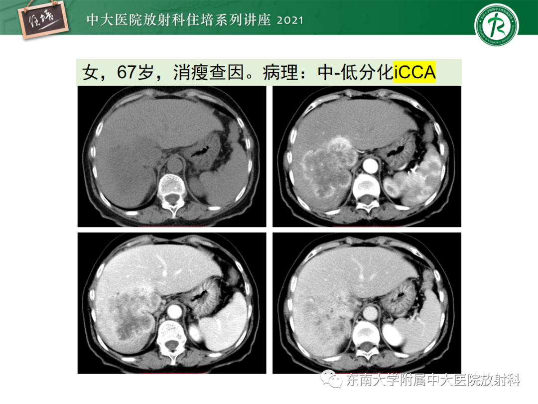 影像PPT - 【PPT】胆管细胞癌的影像表现与鉴别-11