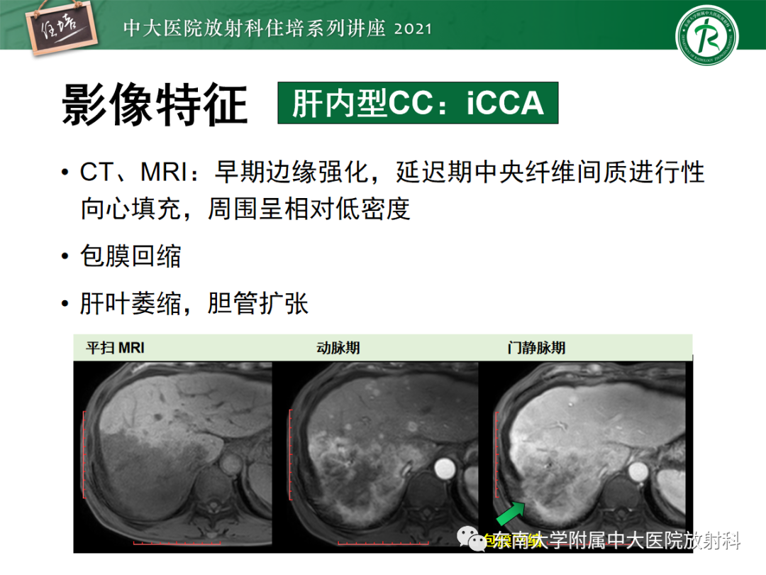 影像PPT - 【PPT】胆管细胞癌的影像表现与鉴别-7
