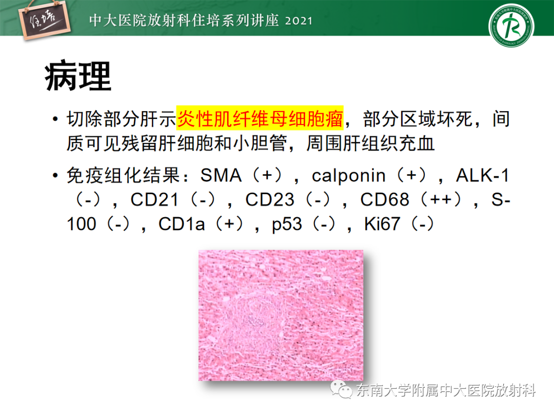 影像PPT - 【PPT】胆管细胞癌的影像表现与鉴别-13