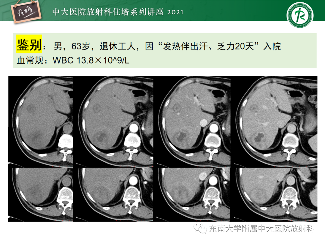 影像PPT - 【PPT】胆管细胞癌的影像表现与鉴别-12