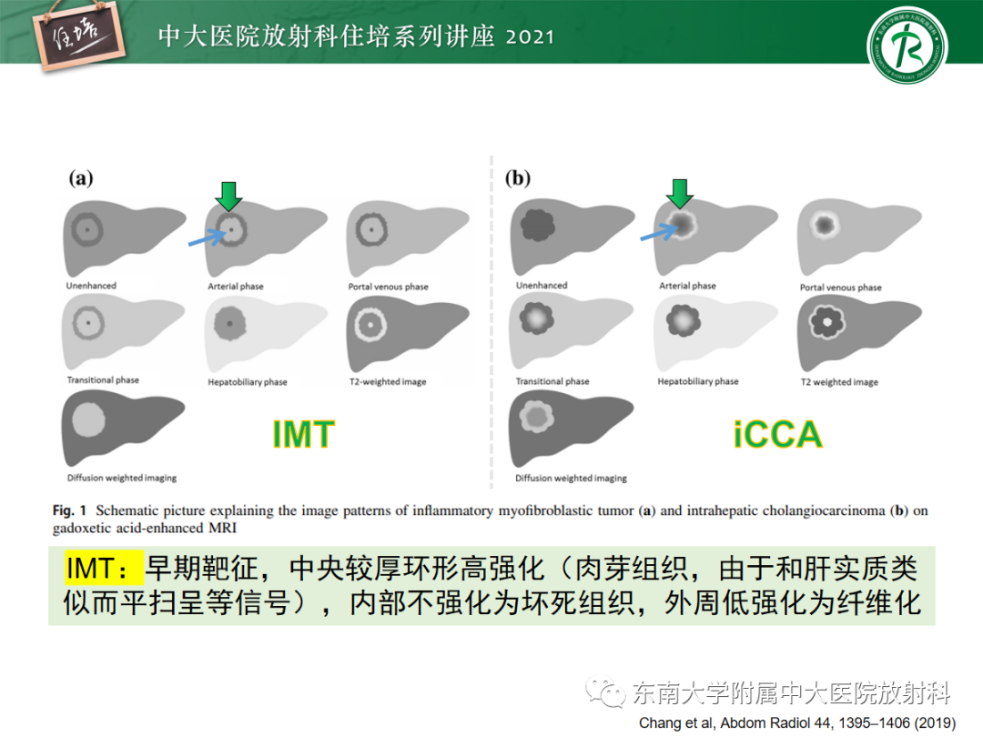 影像PPT - 【PPT】胆管细胞癌的影像表现与鉴别-18