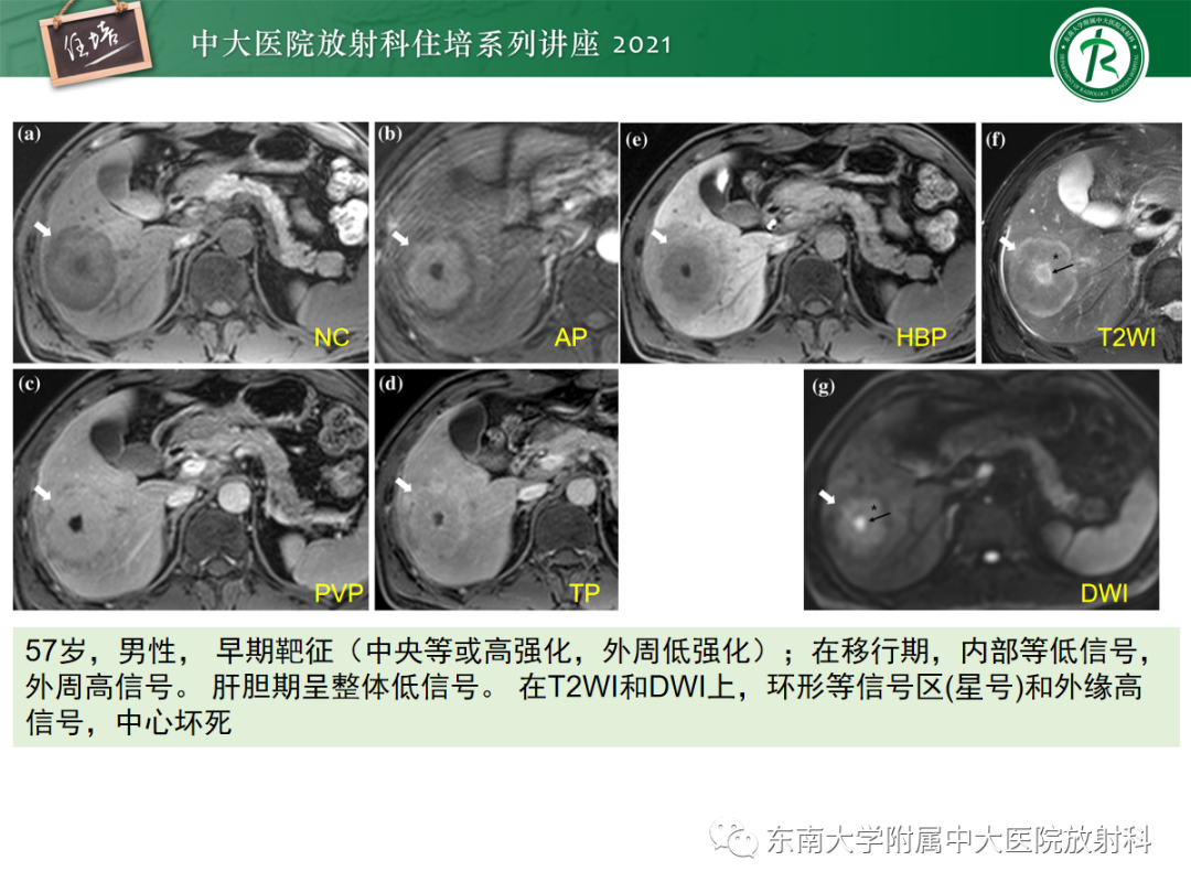 影像PPT - 【PPT】胆管细胞癌的影像表现与鉴别-19