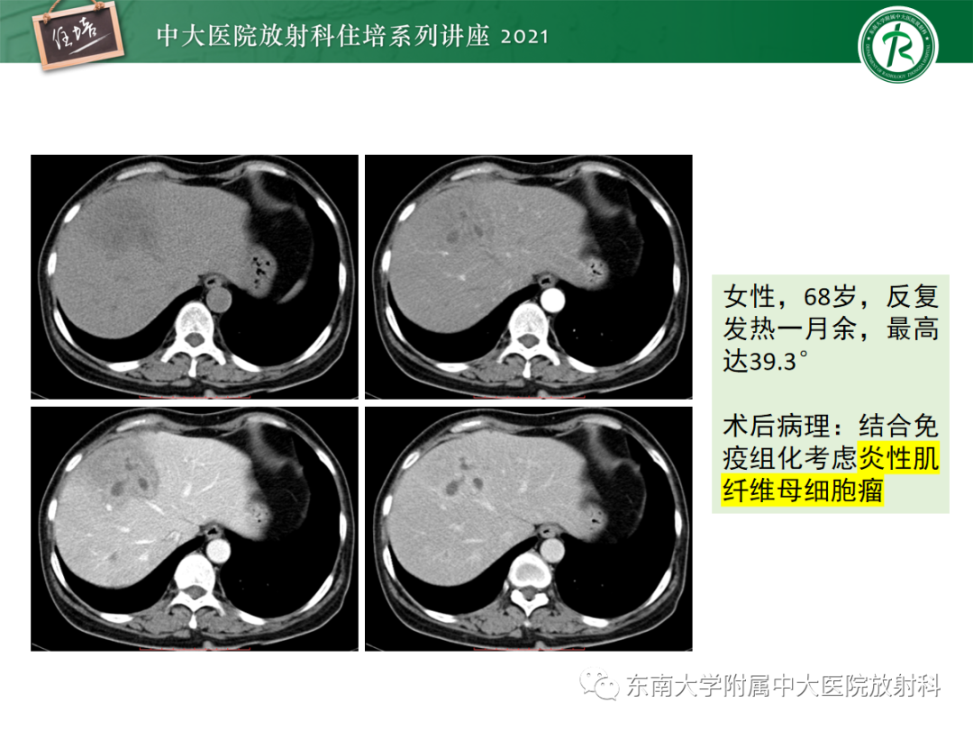 影像PPT - 【PPT】胆管细胞癌的影像表现与鉴别-20