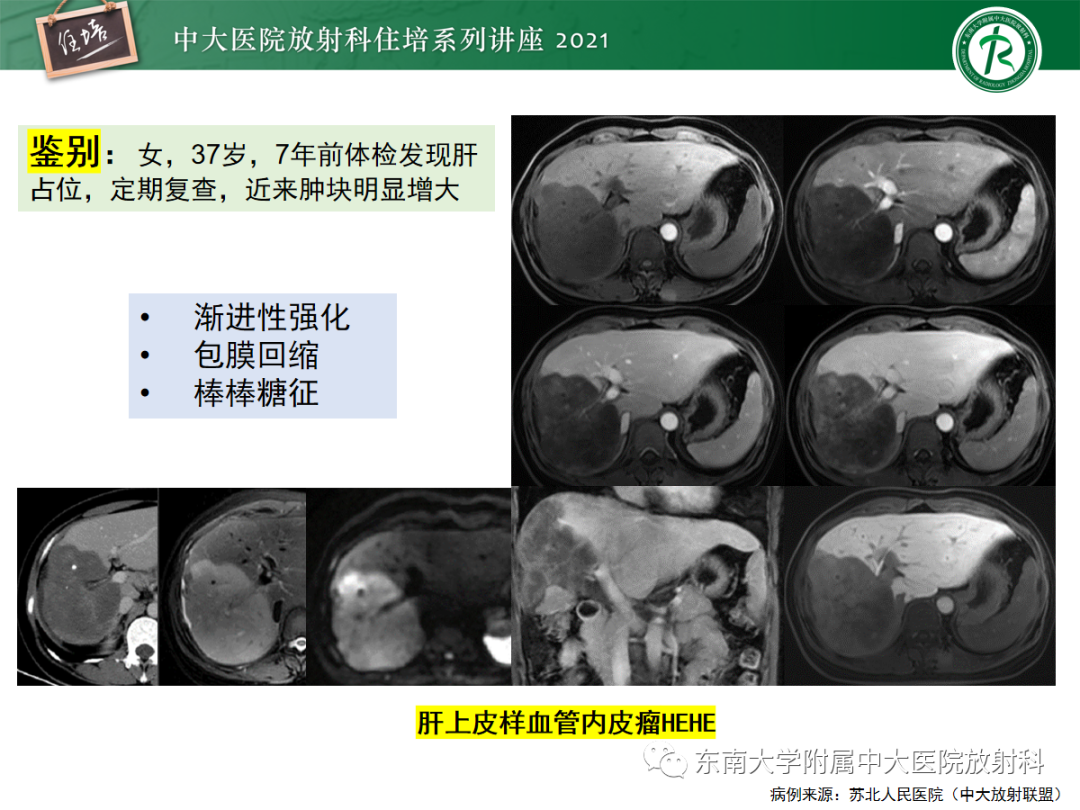 影像PPT - 【PPT】胆管细胞癌的影像表现与鉴别-21