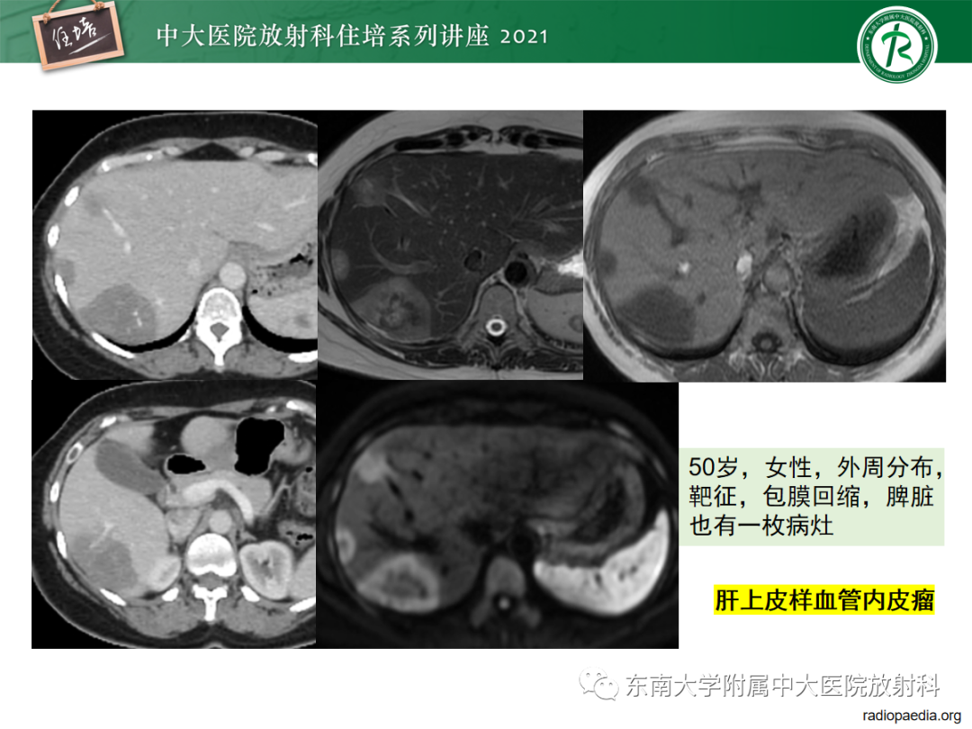 影像PPT - 【PPT】胆管细胞癌的影像表现与鉴别-22