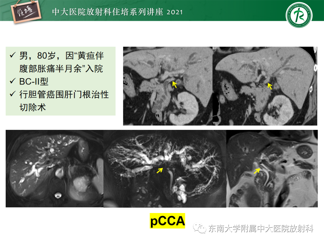影像PPT - 【PPT】胆管细胞癌的影像表现与鉴别-29