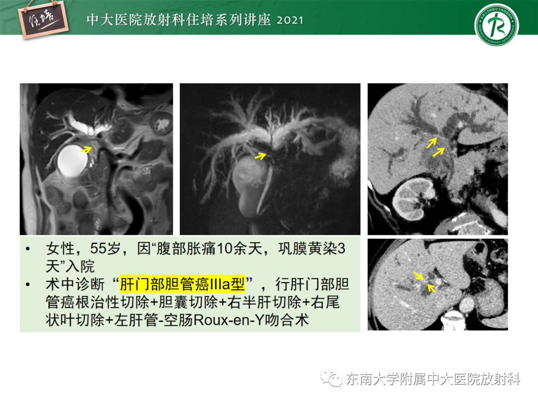 影像PPT - 【PPT】胆管细胞癌的影像表现与鉴别-31