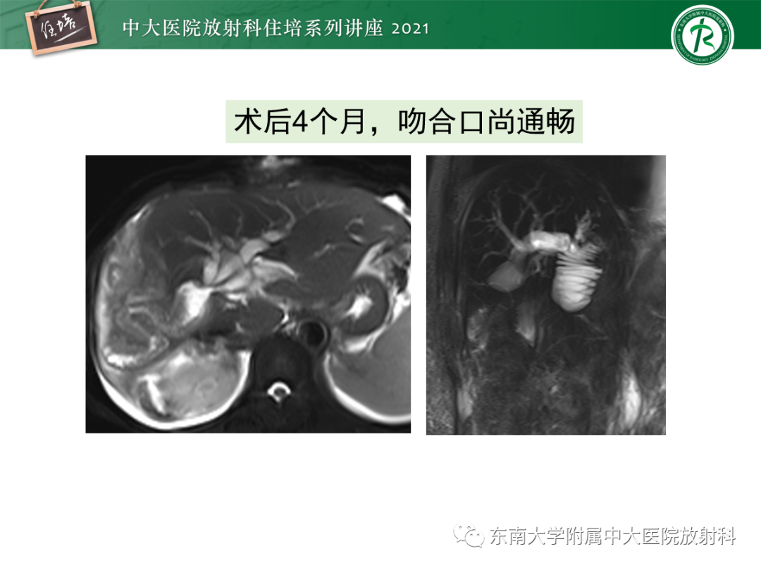 影像PPT - 【PPT】胆管细胞癌的影像表现与鉴别-33