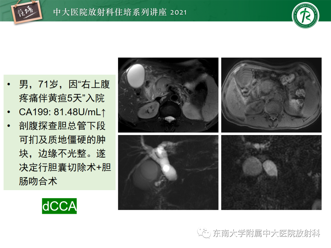 影像PPT - 【PPT】胆管细胞癌的影像表现与鉴别-35