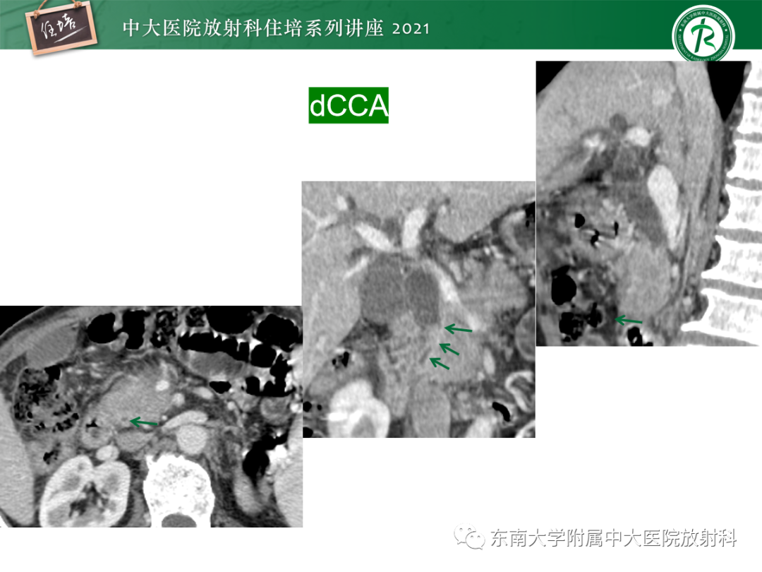 影像PPT - 【PPT】胆管细胞癌的影像表现与鉴别-36