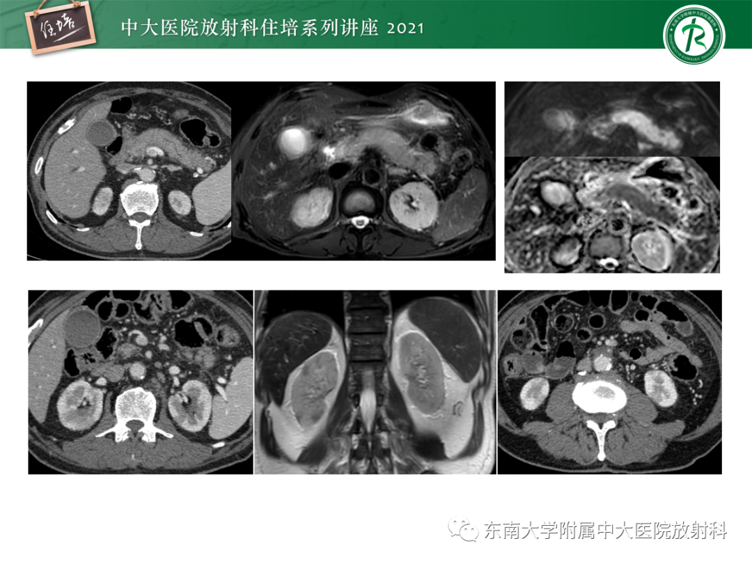 影像PPT - 【PPT】胆管细胞癌的影像表现与鉴别-39