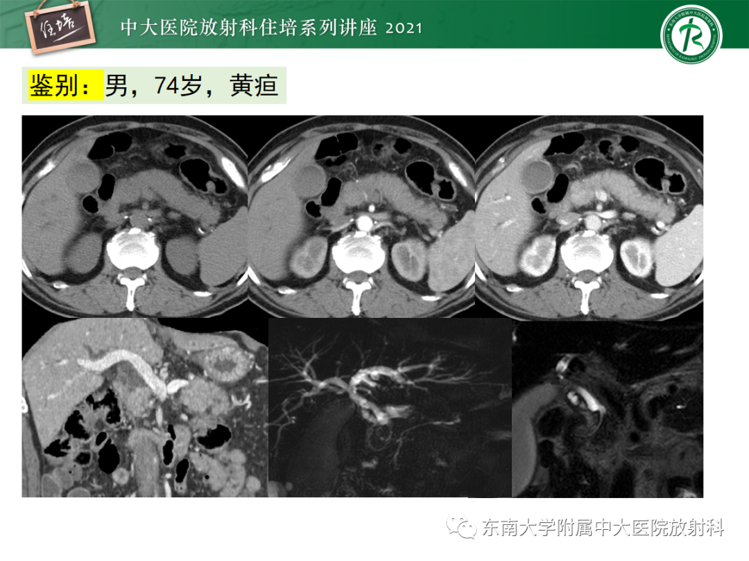影像PPT - 【PPT】胆管细胞癌的影像表现与鉴别-38