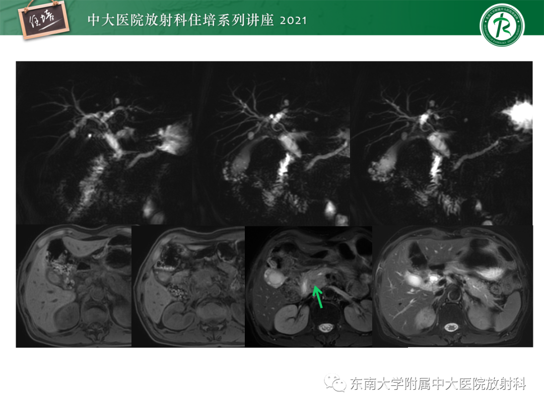影像PPT - 【PPT】胆管细胞癌的影像表现与鉴别-42
