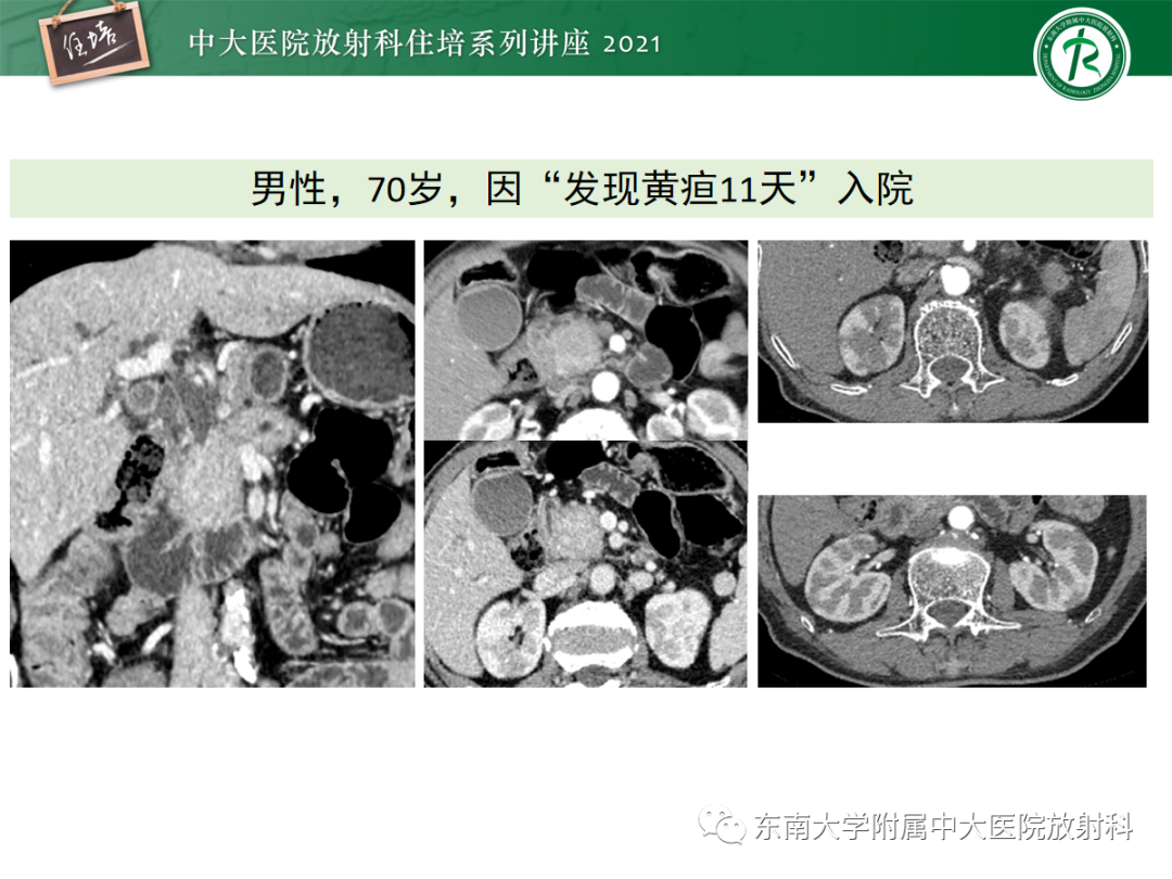 影像PPT - 【PPT】胆管细胞癌的影像表现与鉴别-41