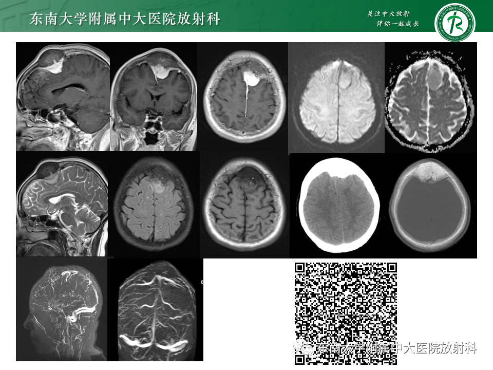 影像PPT - 【PPT】千变万化脑膜瘤-2