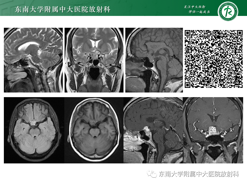 影像PPT - 【PPT】千变万化脑膜瘤-6
