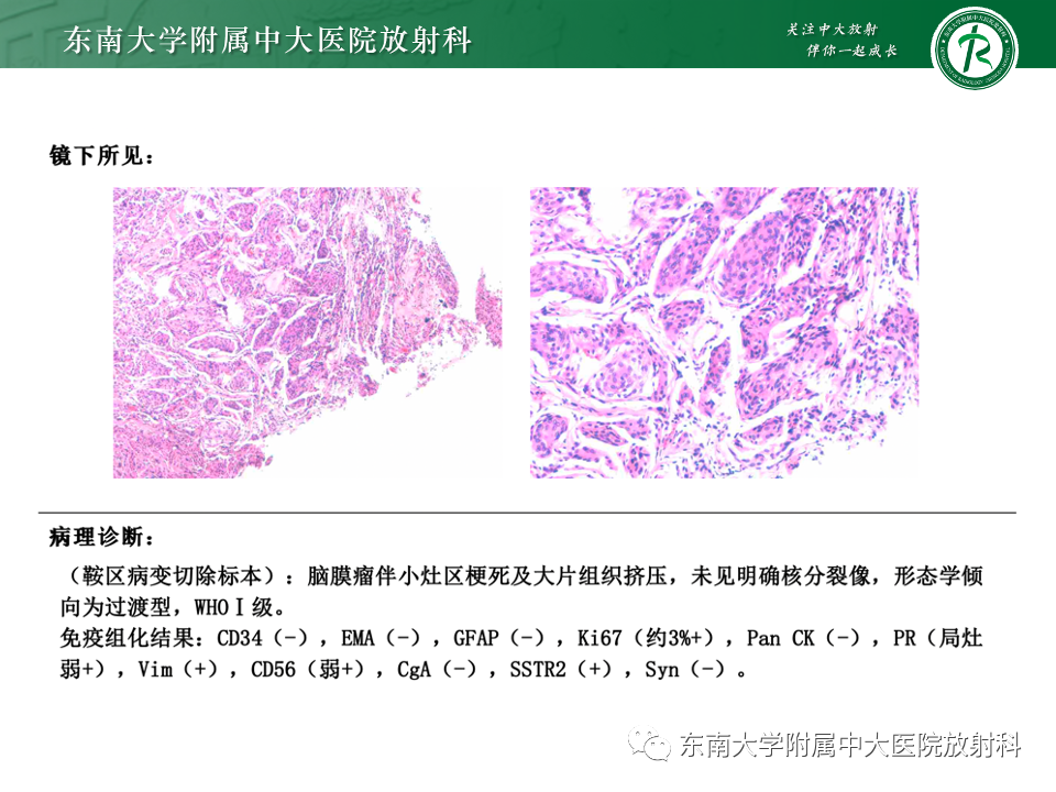 影像PPT - 【PPT】千变万化脑膜瘤-7
