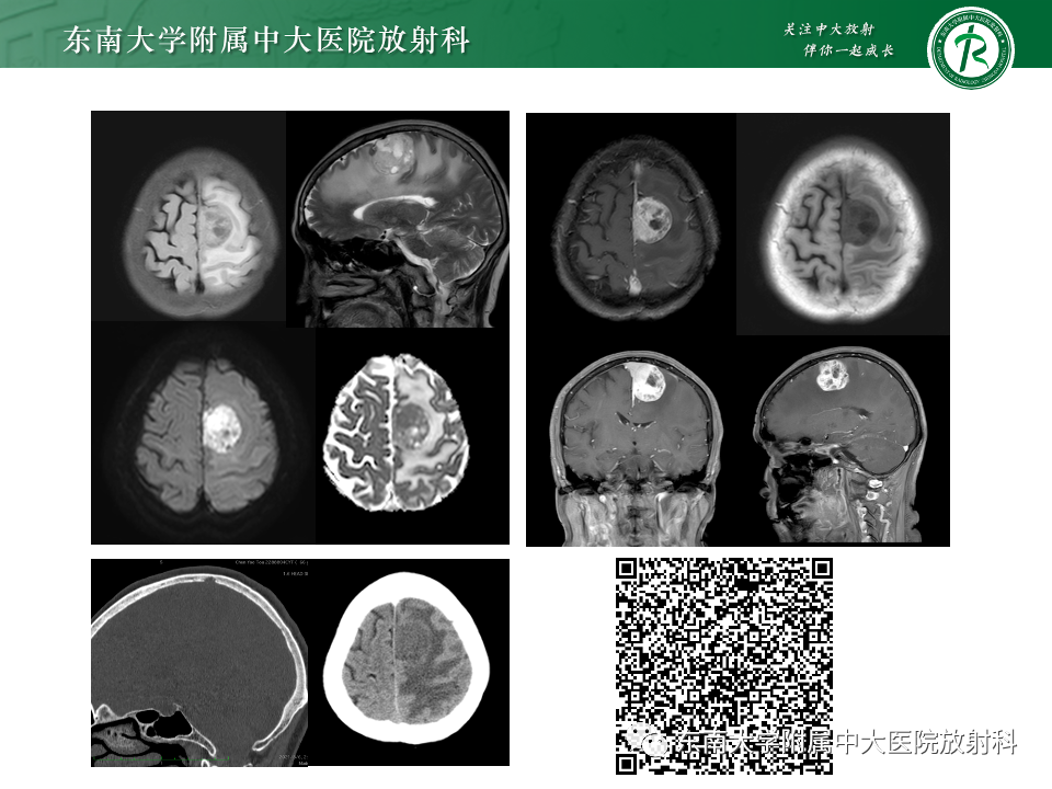 影像PPT - 【PPT】千变万化脑膜瘤-10