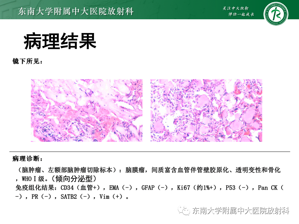 影像PPT - 【PPT】千变万化脑膜瘤-11