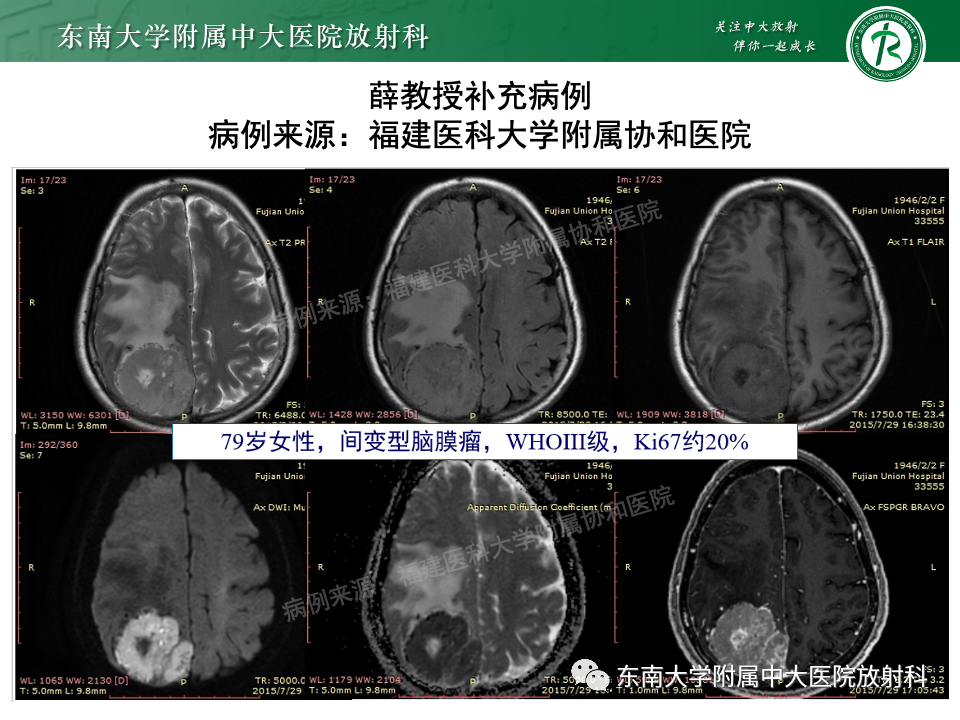 影像PPT - 【PPT】千变万化脑膜瘤-14