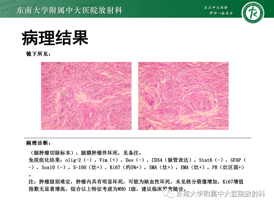影像PPT - 【PPT】千变万化脑膜瘤-17