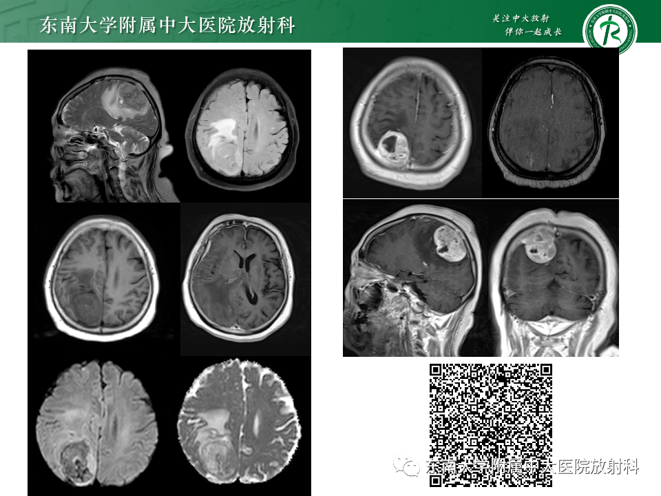 影像PPT - 【PPT】千变万化脑膜瘤-16