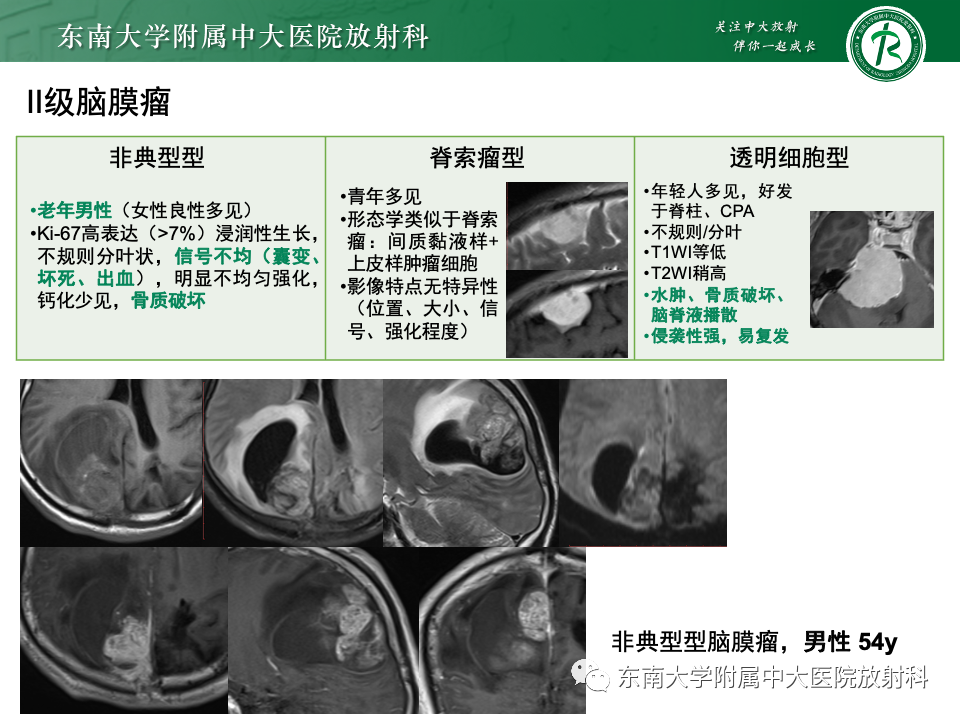 影像PPT - 【PPT】千变万化脑膜瘤-31