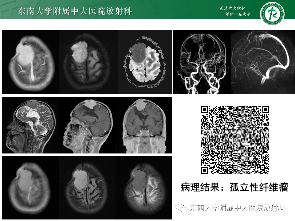 影像PPT - 【PPT】千变万化脑膜瘤-37