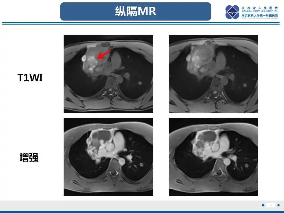 影像PPT - 【PPT】原发性纵隔绒毛膜癌-6