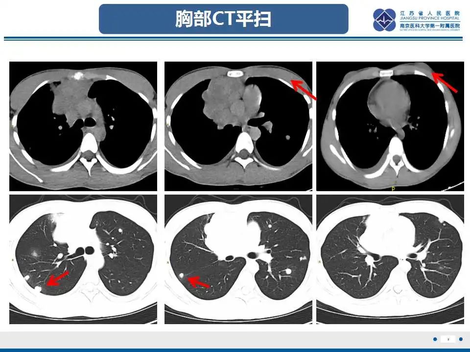影像PPT - 【PPT】原发性纵隔绒毛膜癌-3