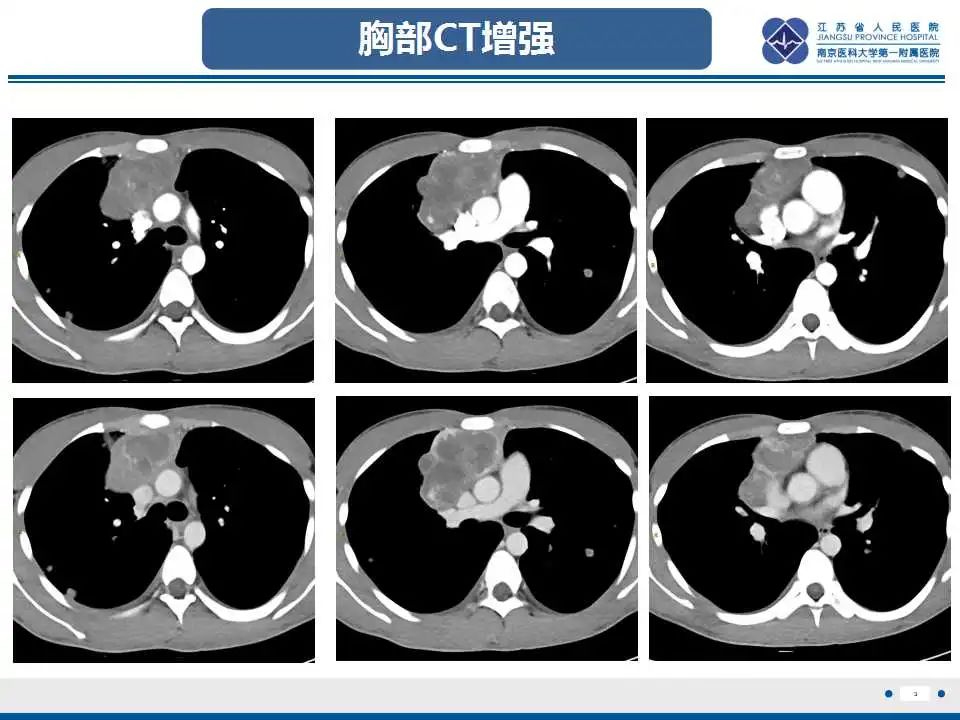 影像PPT - 【PPT】原发性纵隔绒毛膜癌-4