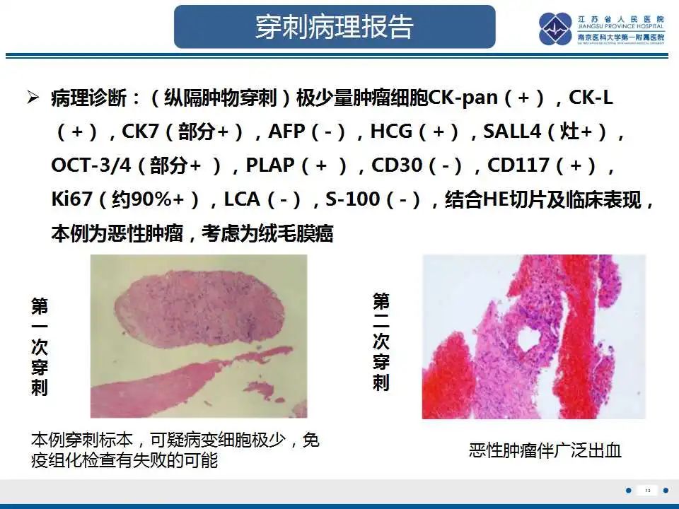 影像PPT - 【PPT】原发性纵隔绒毛膜癌-14