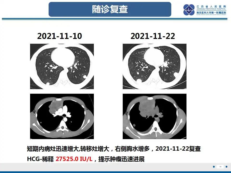 影像PPT - 【PPT】原发性纵隔绒毛膜癌-15