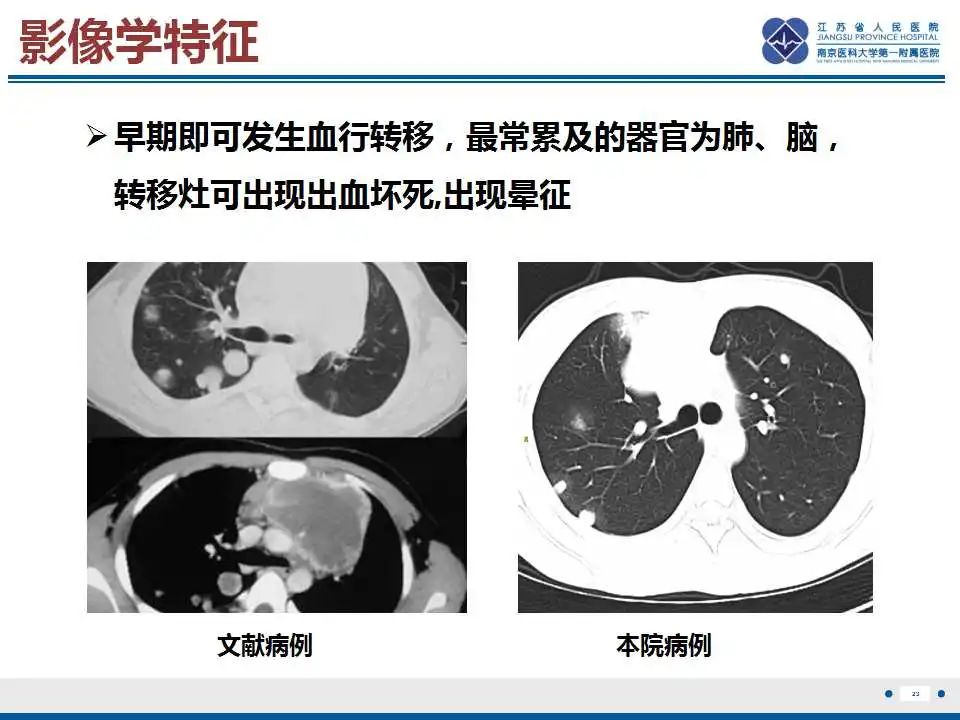 影像PPT - 【PPT】原发性纵隔绒毛膜癌-24