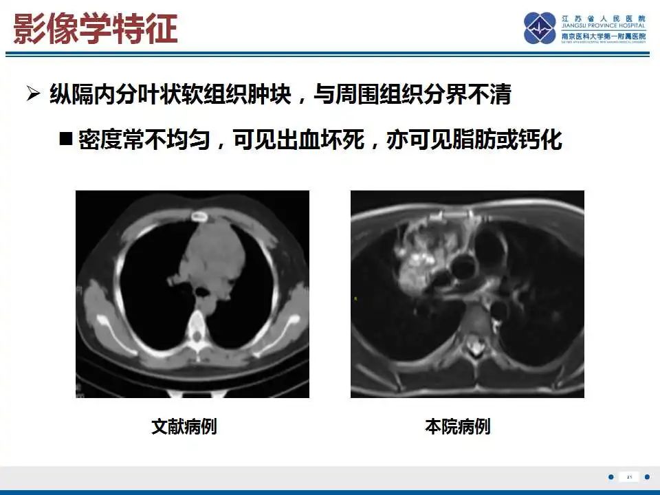 影像PPT - 【PPT】原发性纵隔绒毛膜癌-22