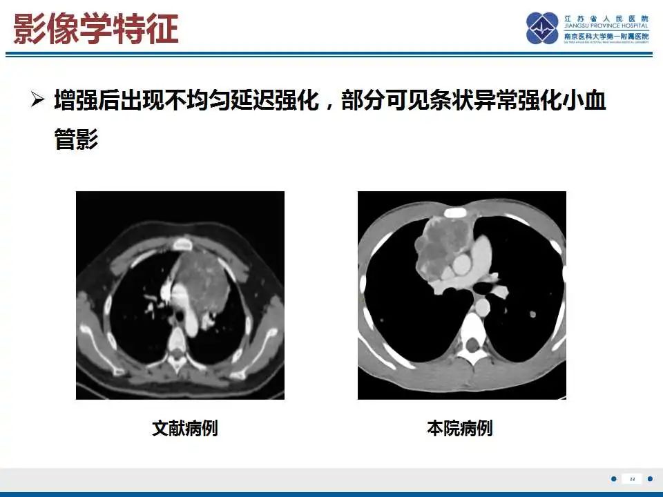 影像PPT - 【PPT】原发性纵隔绒毛膜癌-23