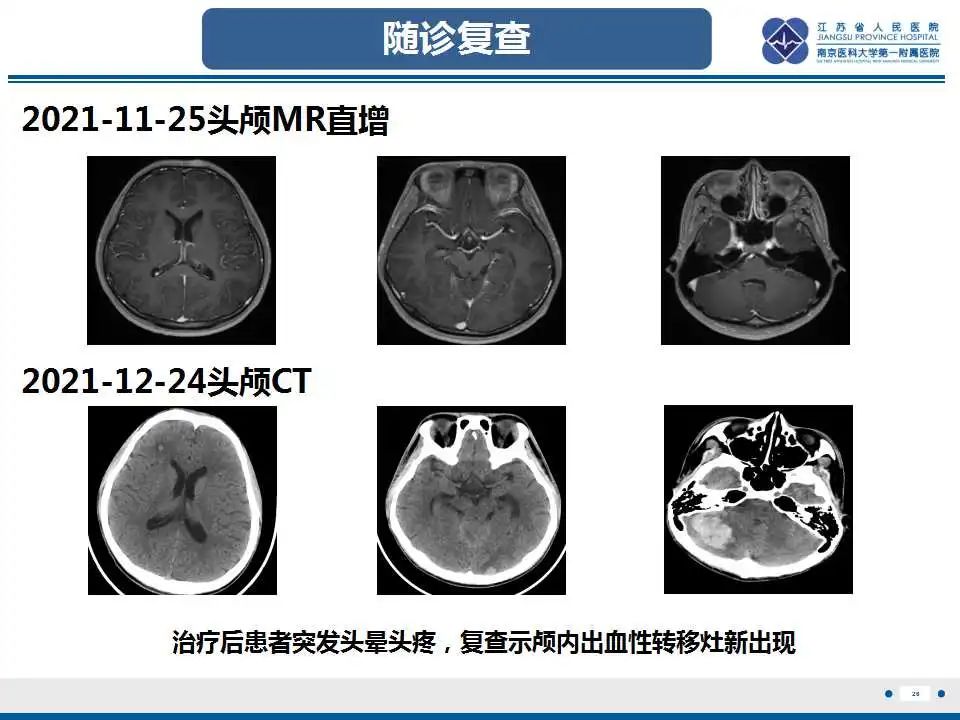 影像PPT - 【PPT】原发性纵隔绒毛膜癌-27