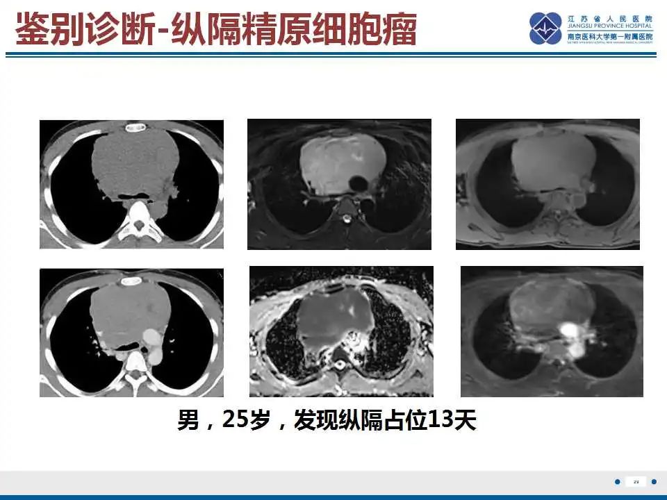 影像PPT - 【PPT】原发性纵隔绒毛膜癌-30